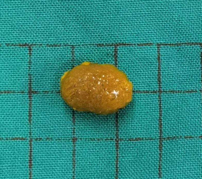 結石會伴隨一生嗎_豹龜會結石嗎_結石會引起性功能嗎