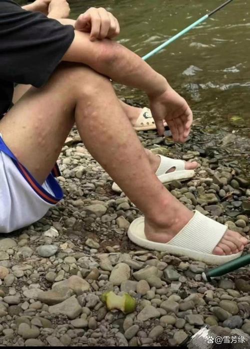 紅火蟻咬傷處理_垂釣被螞蟻咬傷_夏季夜晚釣魚安全