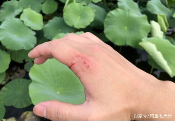 浙江男子野外釣魚時被不明大魚咬傷，網友：大意了！沒有閃